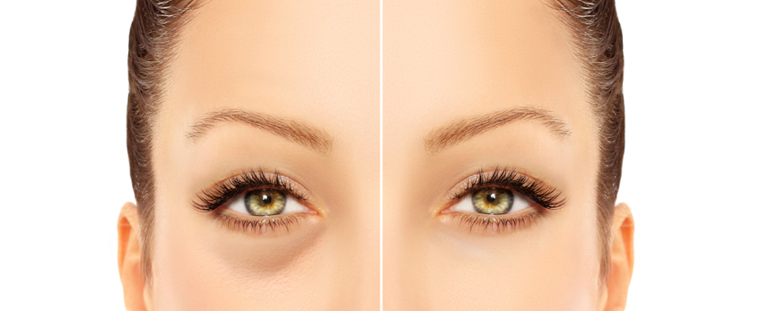 Eyes dark circles - causes, concealment and treatment