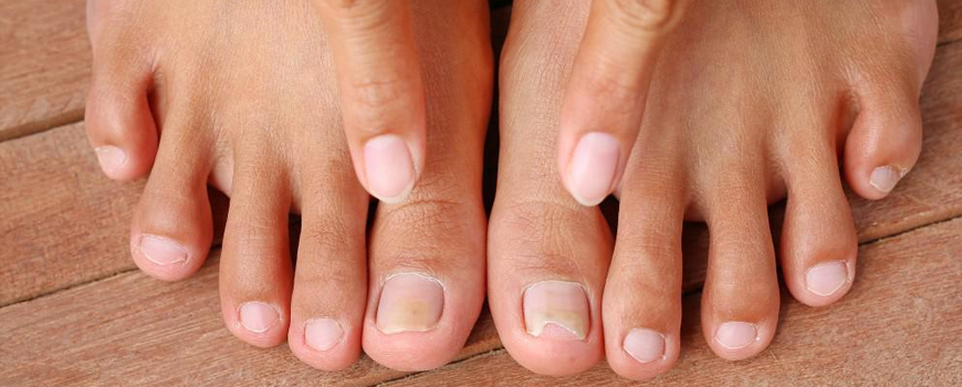 Nail fungus - useful tips, folk medicine and prevention