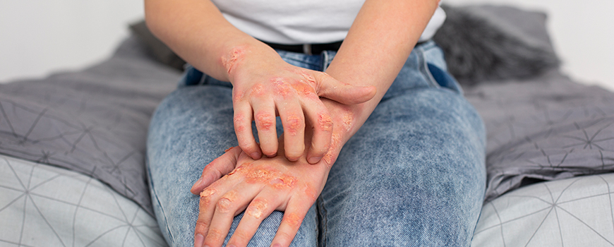 Psoriasis: causes, symptoms, treatment, folk recipes and health products