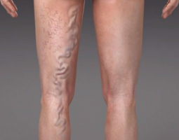 Varicose veins - useful information and folk recipes